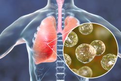 Грибковая пневмония: особенности течения и лечения