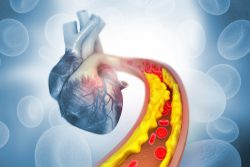 Атеросклероз аорты сердца – что это такое, симптомы, принципы лечения