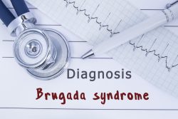 Синдром Бругада: причины, симптомы, ЭКГ-признаки, принципы лечения