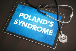 Синдром Поланда: признаки, принципы лечения