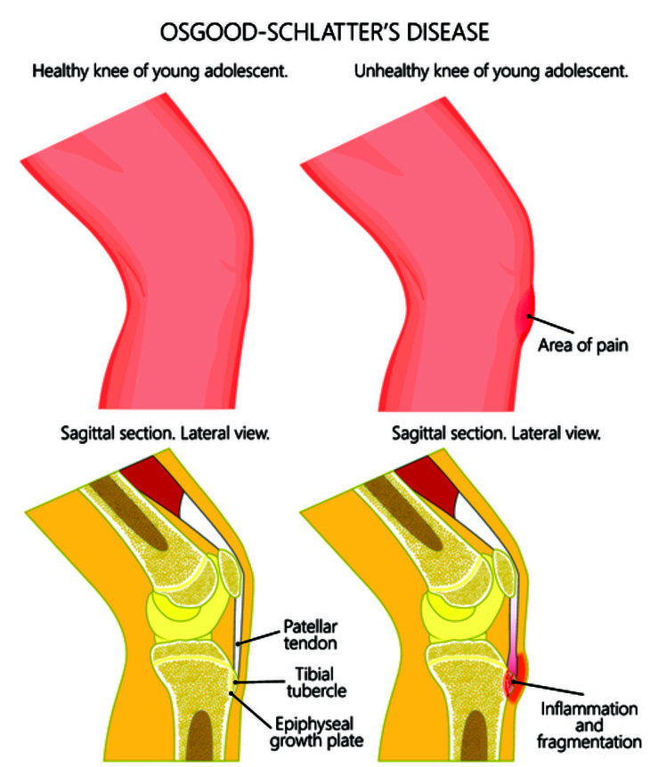 Болезнь осгуда шлаттера фото